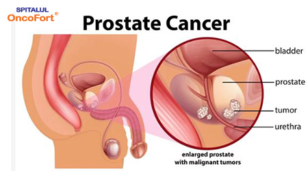 Cancerul de prostată și depresia asociată acestui diagnostic - prezentare caz
